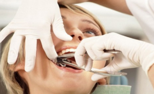 Teeth removal